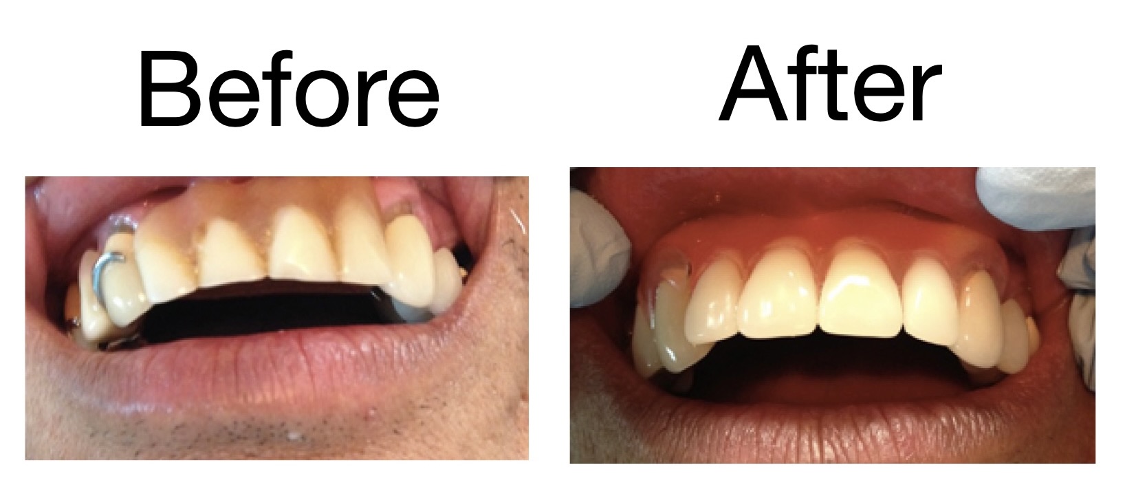 Smile Gallery Dental Before Afters Fremont CA Smile Gallery Dental Before Afters Fremont CA